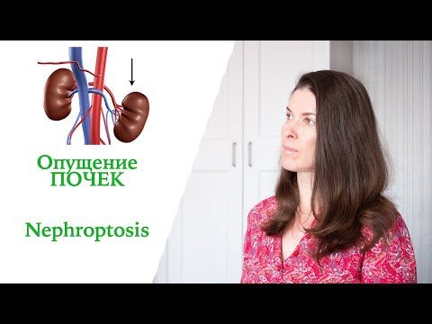 Видео: Опущение Почек. Мой Опыт. Нефроптоз  /1/  Nephroptosis. My case.