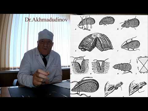 Видео: Опер. на органах брюшной полости. Часть 2. Ревизия