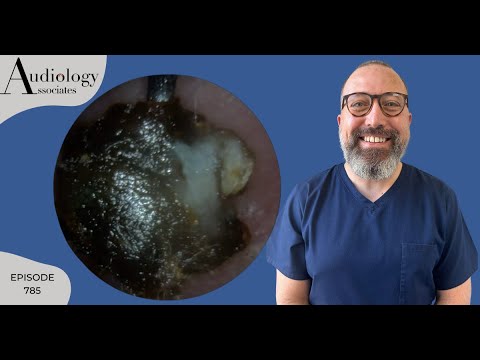 Видео: Удаления толстых ушных серных пробок и огрубевшей кожи из ушей - EP785