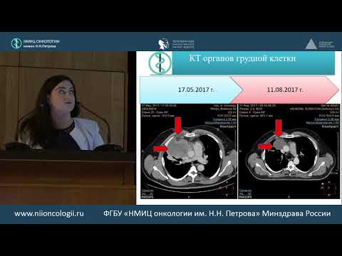 Видео: Внегонадная герминогенная несеменомная опухоль средостения