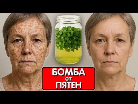 Видео: Не поверила, но пятна исчезли! Маска, которая СТИРАЕТ ПИГМЕНТНЫЕ ПЯТНА с первого раза ПРОВЕРЕНО !