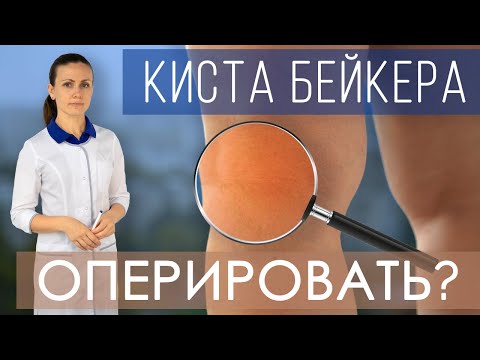 Видео: Киста Бейкера. Как лечить кисту Бейкера коленного сустава? Всегда ли нужно оперировать? Упражнения.