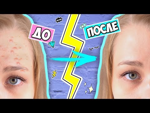 Видео: КАК ИЗБАВИТЬСЯ от ПРЫЩЕЙ НАВСЕГДА ♡ RINA