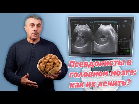 Видео: Псевдокисты в головном мозге: как их лечить? - Доктор Комаровский