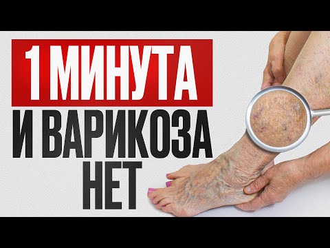 Видео: ЭТО спасет вас от ВАРИКОЗА! / ПРОСТЫЕ способы устранить варикозное расширение вен