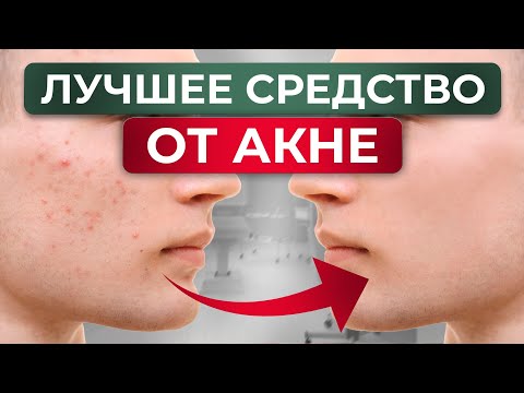 Видео: Фотодинамическая ТЕРАПИЯ / НОВЫЙ метод в лечении акне и гиперпигментации