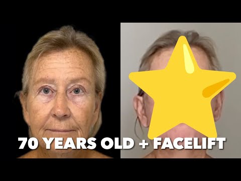 Видео: 70-летний пациент, сделавший подтяжку лица, добился потрясающих результатов всего за 11 дней