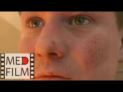 Видео: Атопический дерматит © Atopic dermatitis