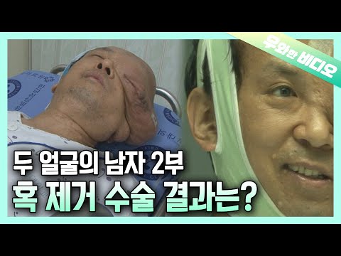 Видео: (Эпизод 2) Удаление шишки, покрывающей половину его лица... Результат...?