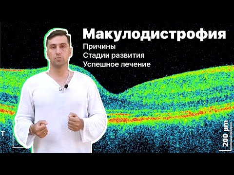 Видео: Макулодистрофия
