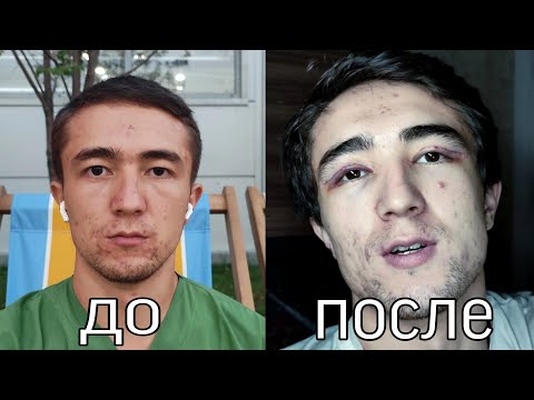 Видео: Блефаропластика до и после, моя история "красота или разочарование" минусы и плюсы