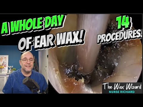 Видео: Целый день ушной серы! 415 ​​#ухо #ушнаясера #удалениеушнойсеры #asmr #удовлетворение #длявас #fy...