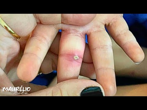 Видео: ИНФЕКЦИЯ ПАЛЬЦЕВ, ВЫЗВАННАЯ БАКТЕРИЯМИ