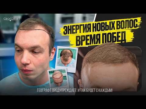 Видео: ВСЯ ПРАВДА О ПЕРЕСАДКЕ ВОЛОС! ИНТЕРВЬЮ ПАЦИЕНТА GEOGRAFT! 