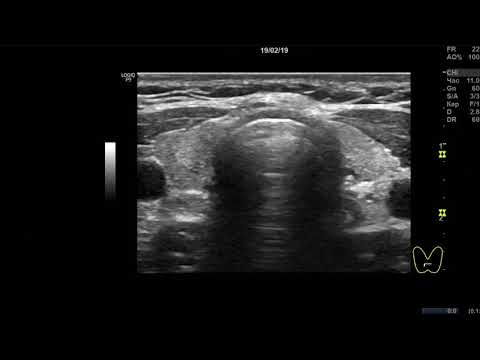 Видео: Клинический случай 9. (УЗИ Щитовидной Железы ) доктор А.В. Ушаков