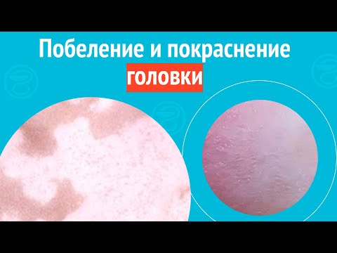 Видео: 😡 Побеление и покраснение головки. Клинический случай №1546