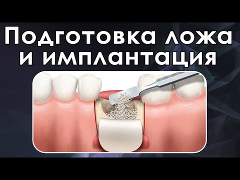 Видео: Расщепление гребня и препарирование ложа под имплантат