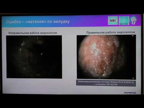 Видео: 06 Пирогов СС Типичные ошибки, которые не позволяют найти ранний рак желудка при гастроскопии