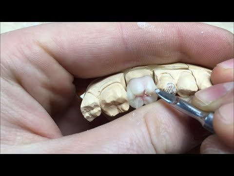 Видео: Waxing.Esthetic WAX-UP)Dental Lab Моделироака 36 з