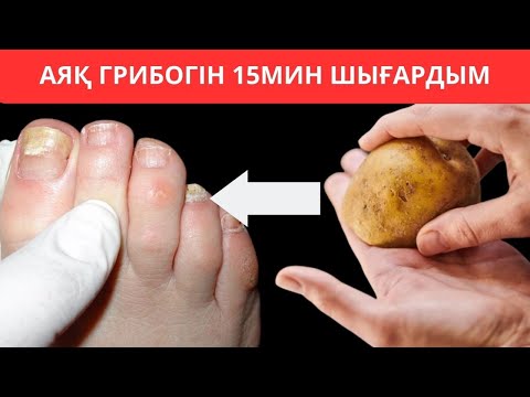 Видео: Тырнақ грибогі әдеттегі әдіспен 15 минутта кетіруге болады... Нақты осы 6 азықты қолдансаң