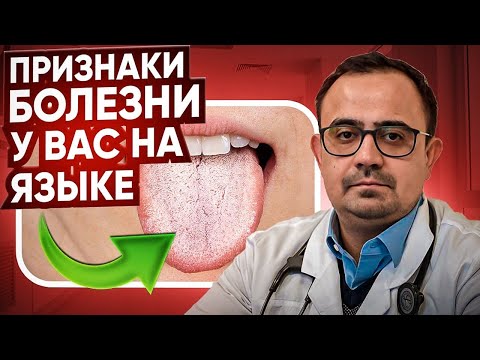 Видео: Ваш ЯЗЫК РАССКАЖЕТ многое о вашем здоровье!