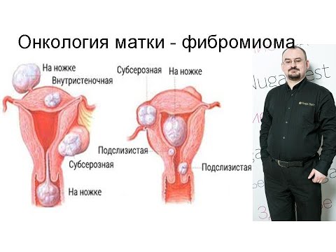 Видео: Онкология матки – фибромиома