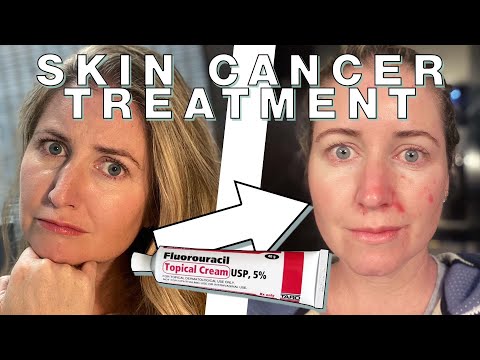 Видео: Лечение рака кожи фторурацилом от Шантель | Skin Deep