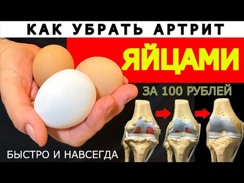 Видео: Артрит БОЛЬ В СУСТАВАХ. Боль в коленях.  Как учила бабушка. JOINT PAIN. Knee pain. RUSSIAN remedy