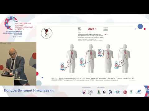 Видео: Чрезкожная мех поддержка КО Попцов В.Н.