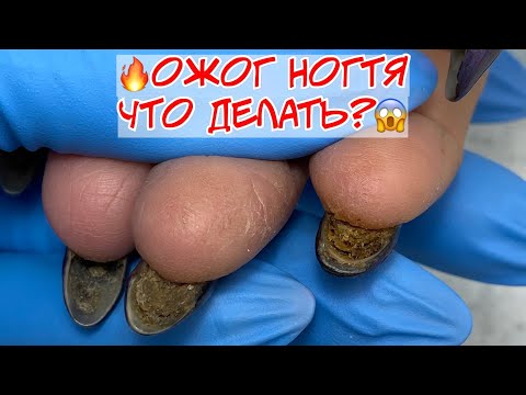 Видео: Ожог ногтевой пластины 🔥 Что делать? Преображение ногтей