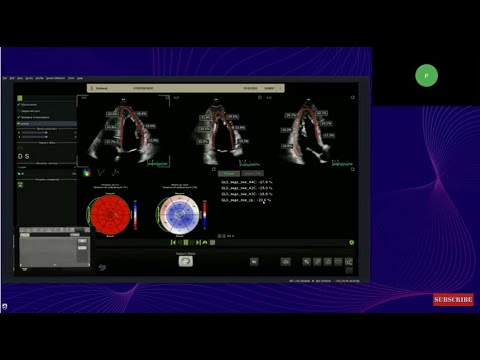 Видео: Проведение стресс-эхокардиографии на ультразвуковых системах Philips EPIQ, Affiniti