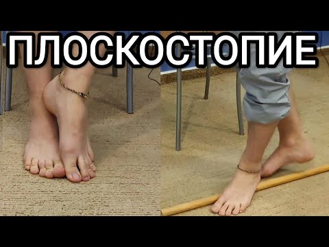 Видео: Лечебная физкультура при ПЛОСКОСТОПИИ - Гимнастика на каждый день