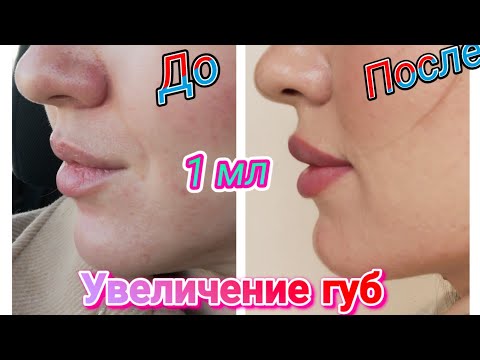 Видео: Увеличение губ 1 мл до / после. Натуральный эффект.TEOSYAL 1мл