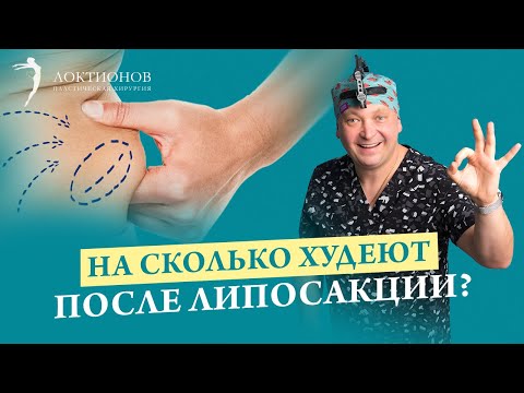 Видео: Можно ли похудеть с помощью липосакции? Сколько жира уйдет после липосакции? | Андрей Локтионов