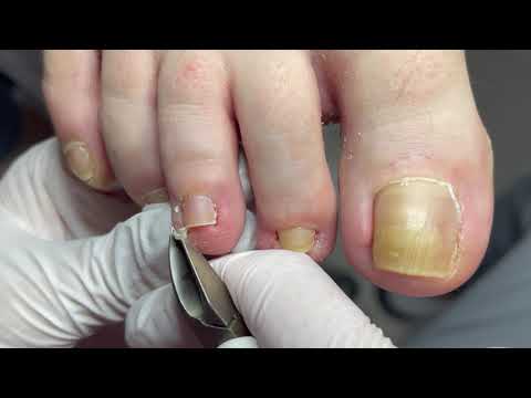 Видео: Онихолизис!Скручивание ногтей!#Нейл78#педикюр#онихолизис#nails#маникюр#грибок#вросшийноготь#мозоль