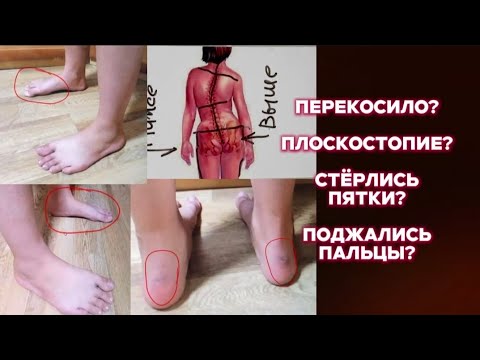 Видео: Почему стёрлись пятки и поджались пальцы? Третья стадия плоскостопия