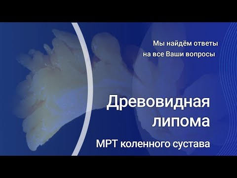 Видео: Древовидная липома