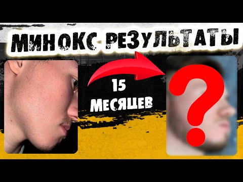 Видео: 15 месяцев на курсе Минокса / как запустить рост бороды? / Выпуск 35 / Андрей борода
