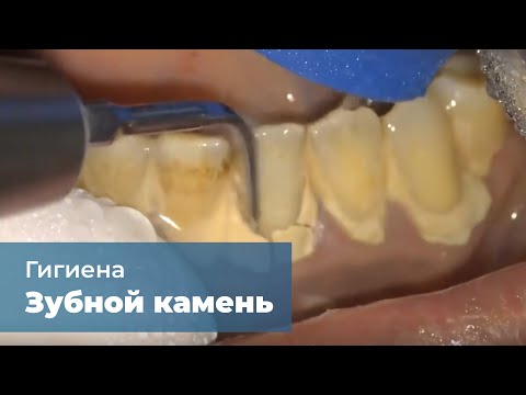 Видео: Удаление зубного камня