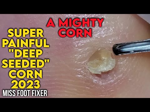 Видео: СУПЕРБОЛЕЗНЕННАЯ "ГЛУБОКАЯ МОЗОЛЬ" 2023 [СИЛЬНАЯ МОЗОЛЬ] ОТ MISS FOOT FIXER
