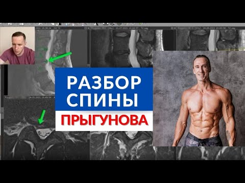 Видео: Спина ПРЫГУНОВА - разбор МРТ в деталях