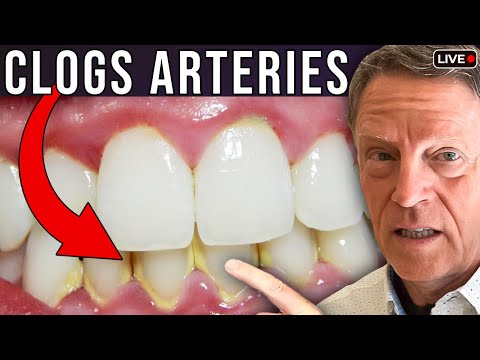Видео: №1 Лучший простой способ удаления зубного налета (избегайте закупорки артерий)