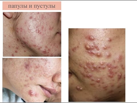 Видео: Лечение АНТИБИОТИКАМИ при акне и розацеа