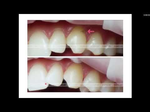 Видео: Кариесология 7. Клиника, дифференциальная диагностика, лечение кариеса