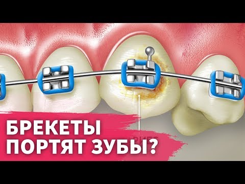 Видео: Брекеты портят эмаль зубов?
