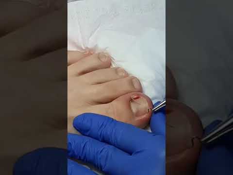 Видео: Лечение вросшего ногтя и установка скобы (видео 4) - Подолог Елена Баскова
