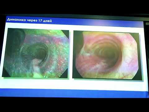 Видео: Бронхо 30 02 Сивокозов ИВ Первый опыт применения EVIS X1 в диагностике и лечении ТБ бронха