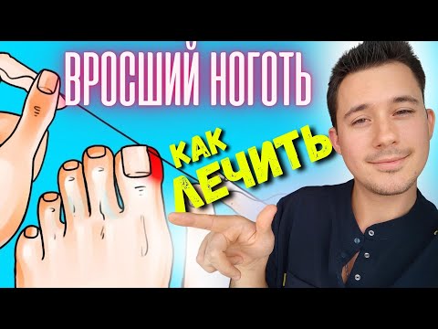 Видео: Ногти. Как лечить вросший ноготь. Коррекция вросшего ногтя.