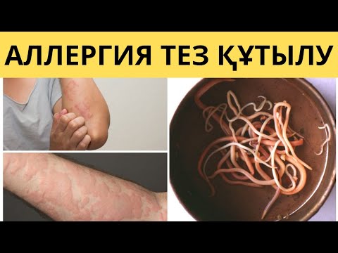 Видео: АЛЛЕРГИЯ ауруын ЖОЯТЫН ТОП 5 ЖОЛ. АЛЛЕРГИЯ қалай КЕТІРУГЕ болады.
