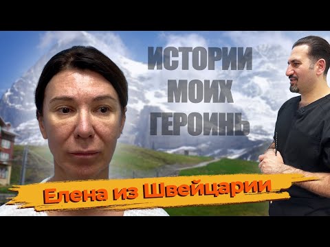Видео: Омоложение лица: Елена из Швейцарии